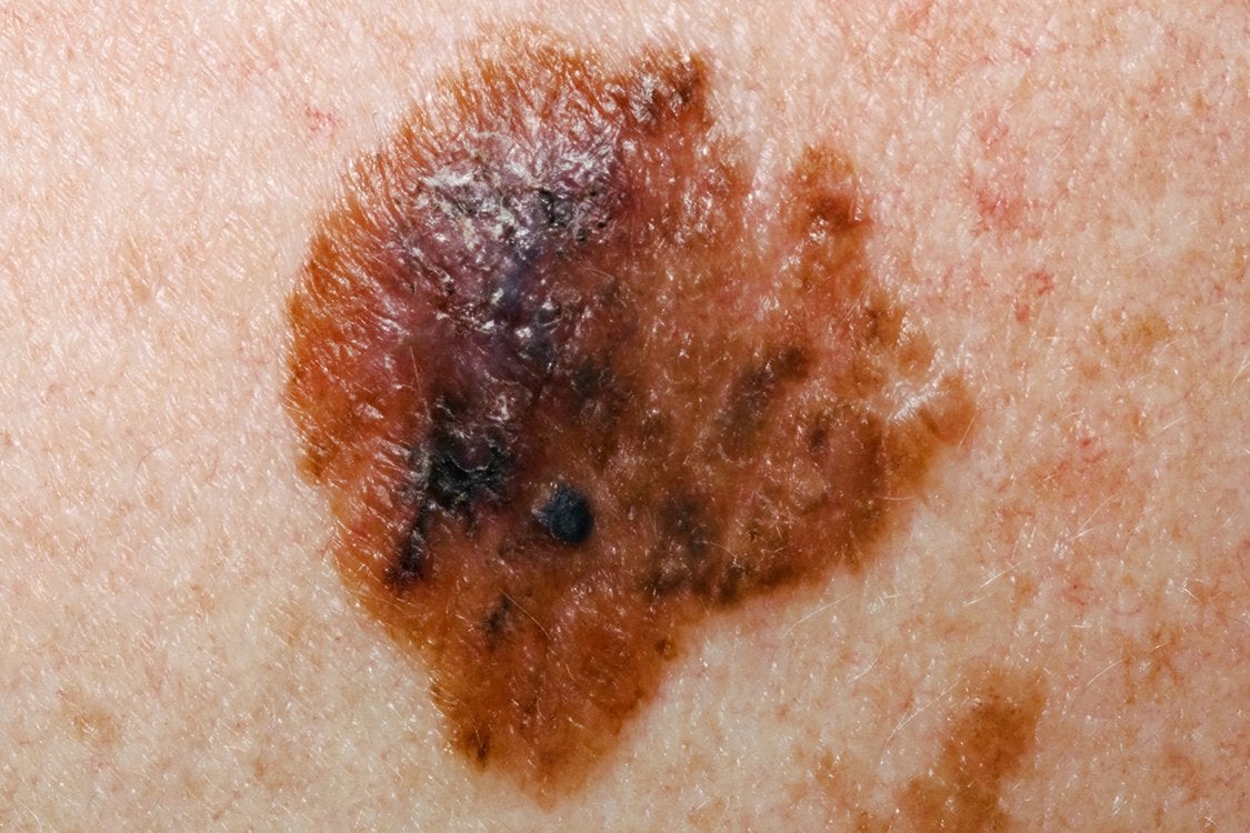 

<p>An example of what melanoma could look like</p>
<p>” height=”750″ width=”1125″ layout=”responsive” i-amphtml-layout=”responsive”><i-amphtml-sizer slot=